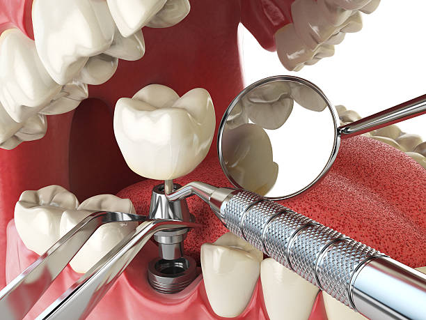 Best Emergency Tooth Extraction in St Paul Park, MN